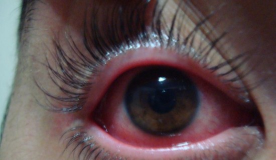 olho-seco-tratamento-e-sintomas-2